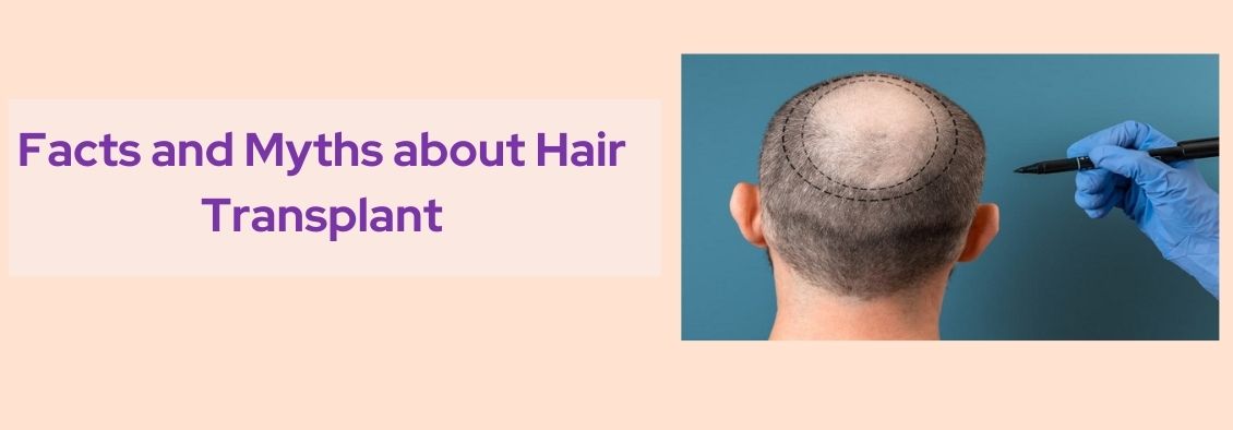 Illustration showing the facts and myths about hair transplant